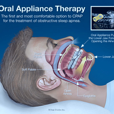 Sleep Apnea Treatment in Hilliard, OH | Fishinger Dental